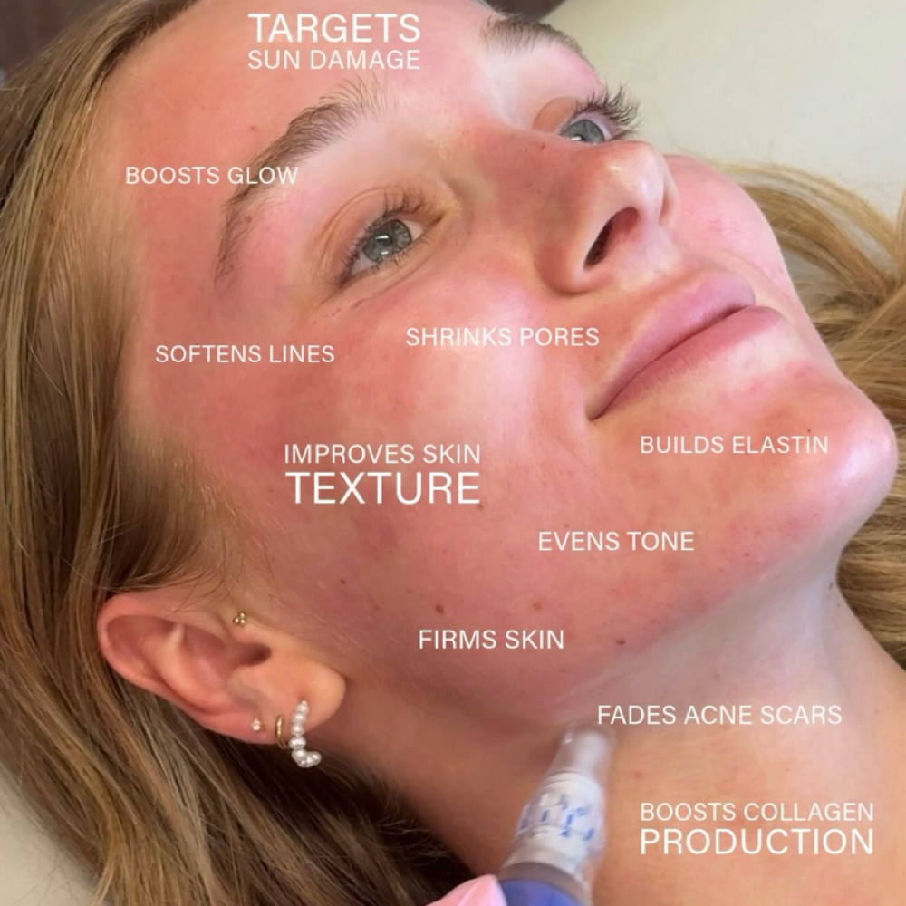 Rejuvenation Microneedling Facial at Glow Beauty Lounge in New Concord, OH