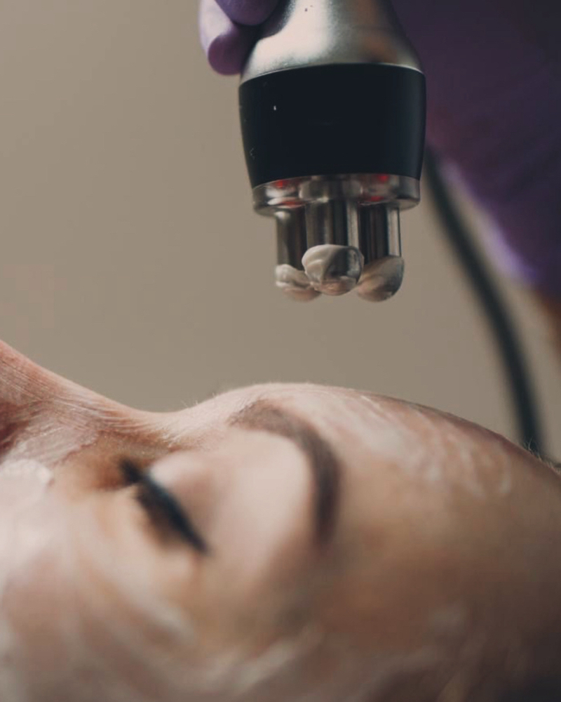 Radiofrequency Facial