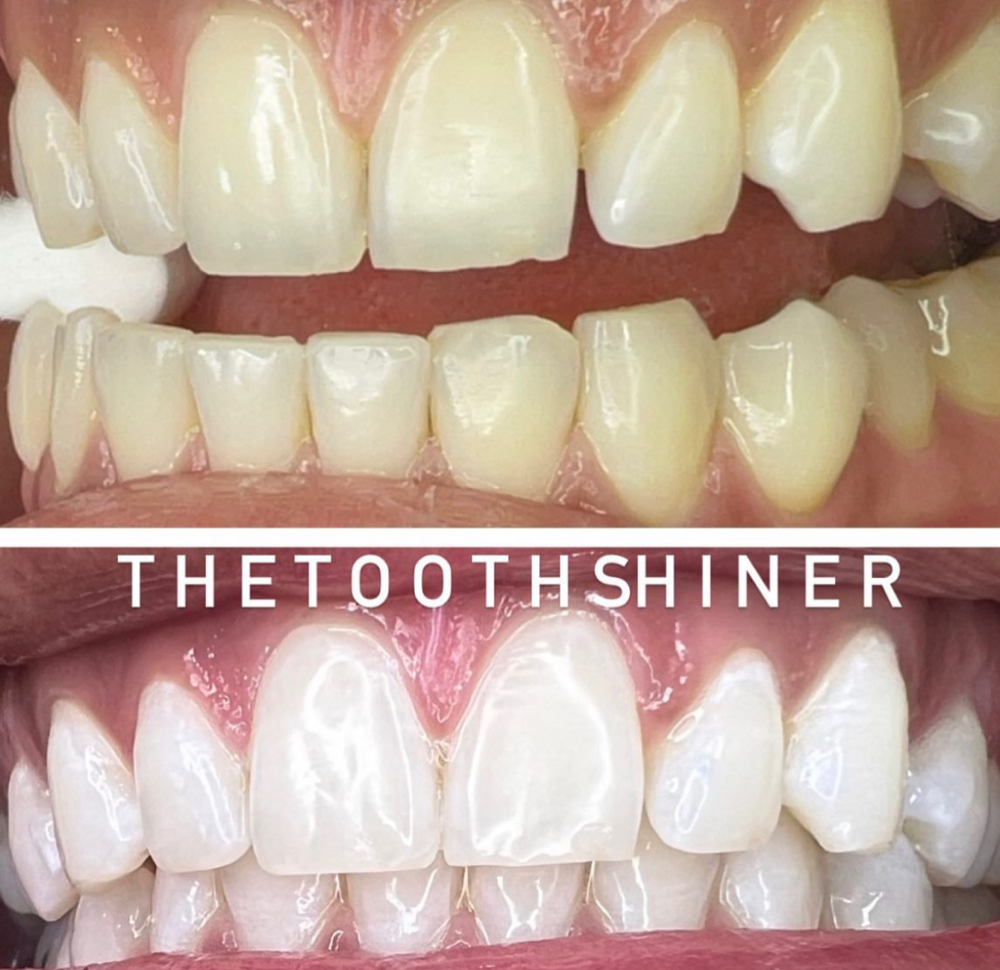 Pro Laser 1 Hour Teeth Whitening