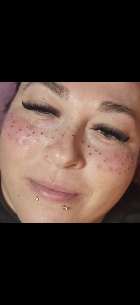 Freckles