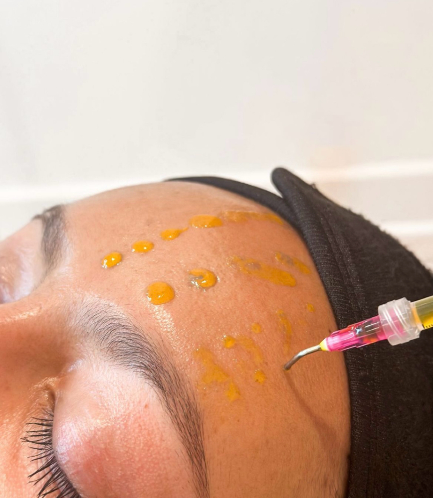 Chemical Peel Only 30 Mins at The Skin Suite 828 in Waynesville, NC