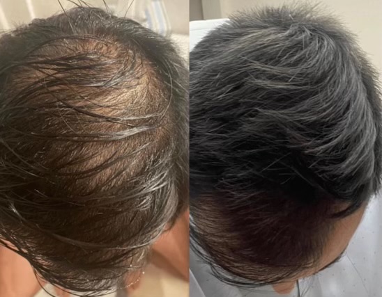 DeRive- Full Head- 1 treatment
