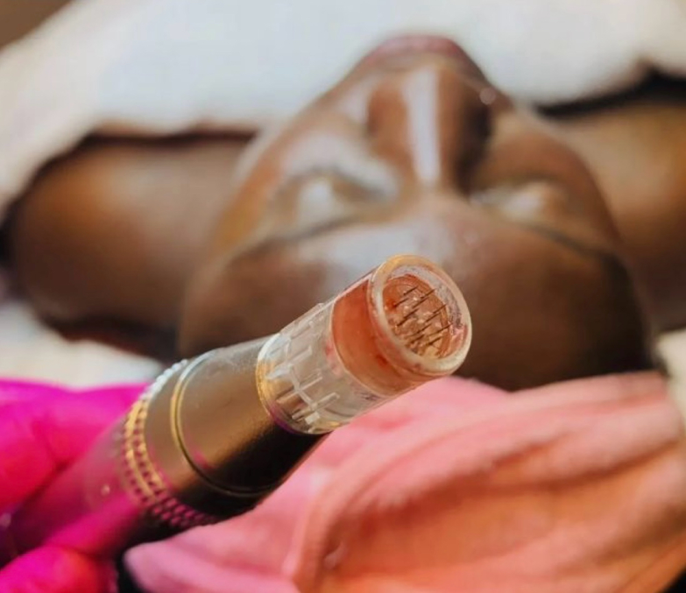 Microneedling