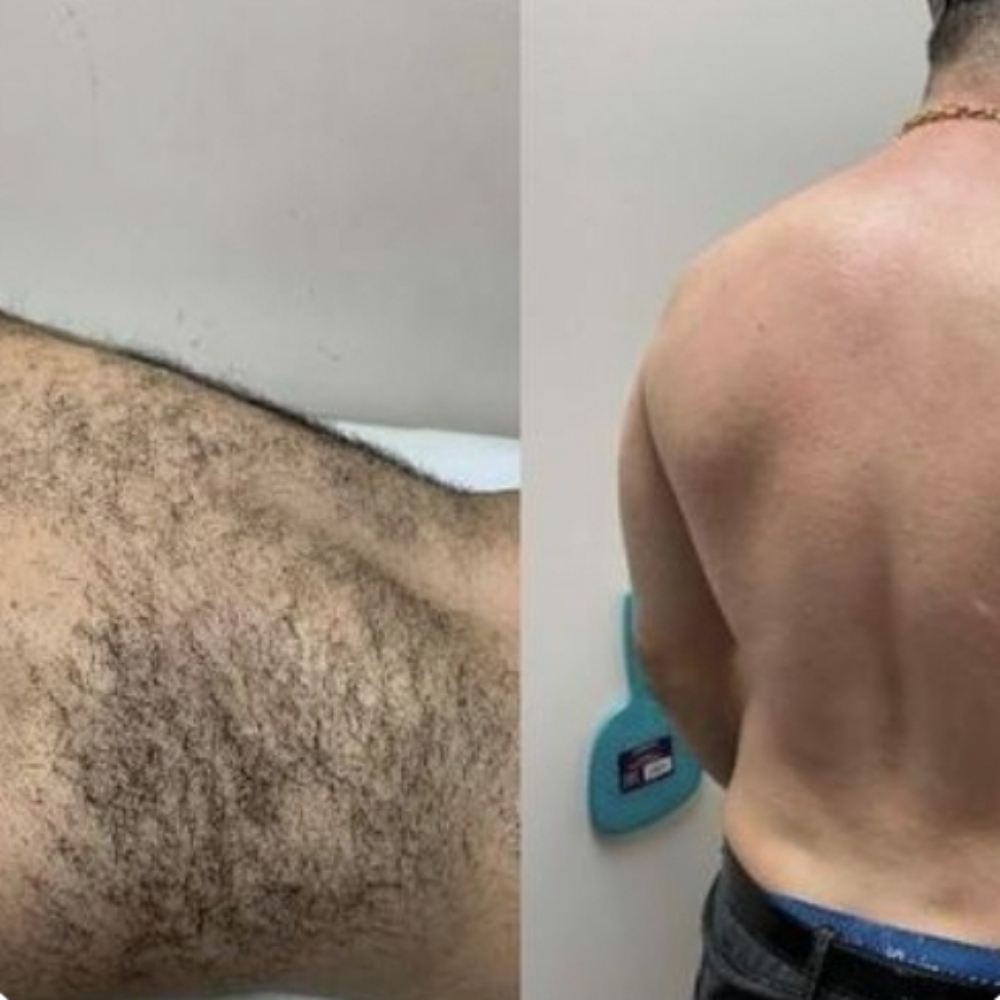 Back wax at NuSkin Facials by Toni in Pink Hill, NC