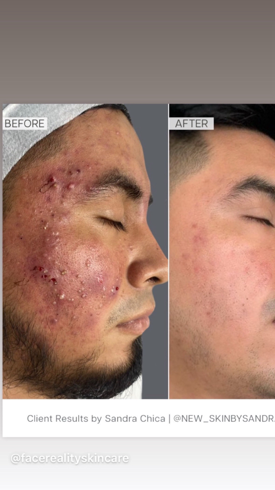 Acne-clearing   Consultation