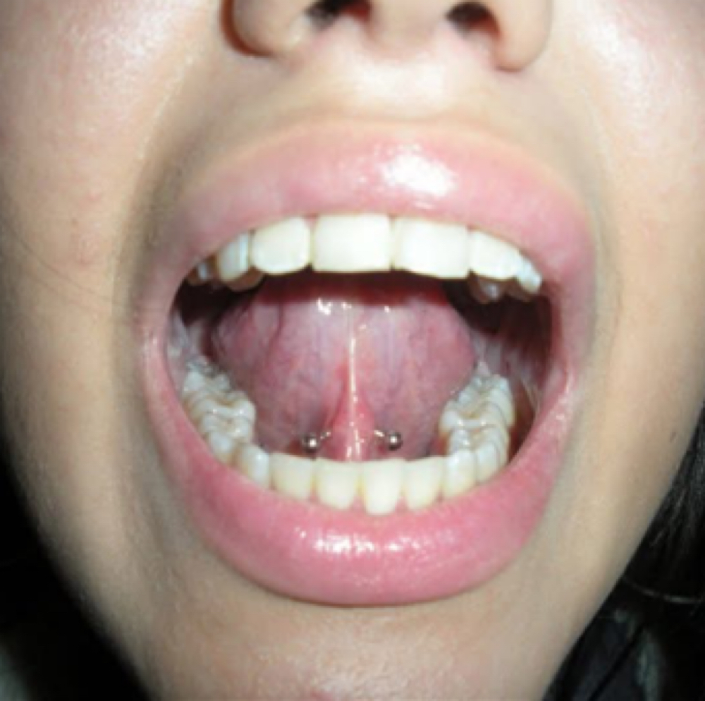 TONGUE WEBBING (LINGUAL FRENULUM) at Crow & Taper in Hanover, PA
