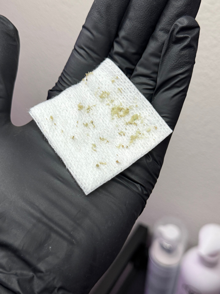 Extraction Facial