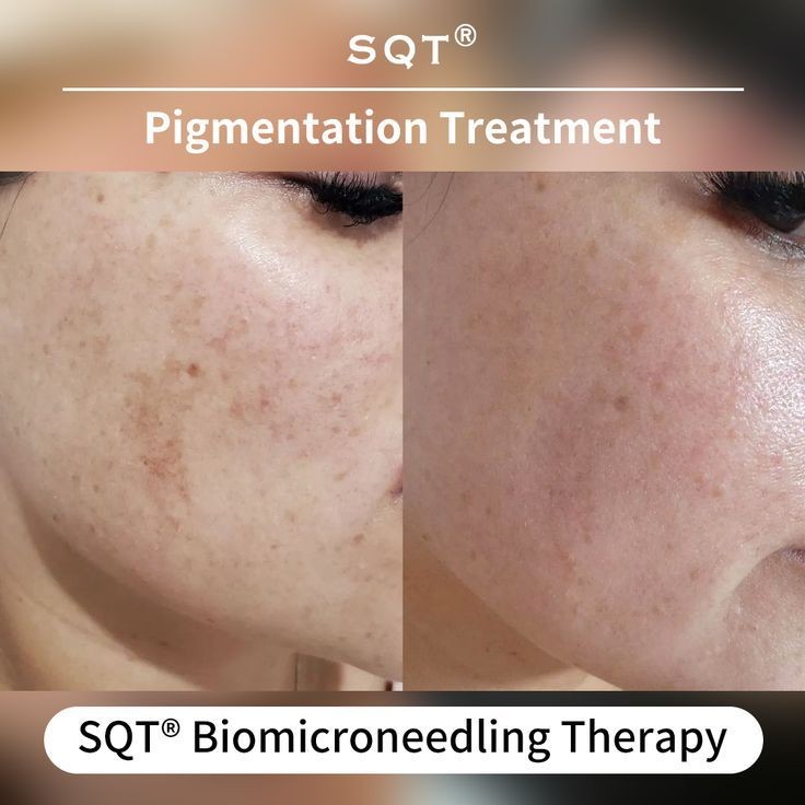 Biomicroneedling