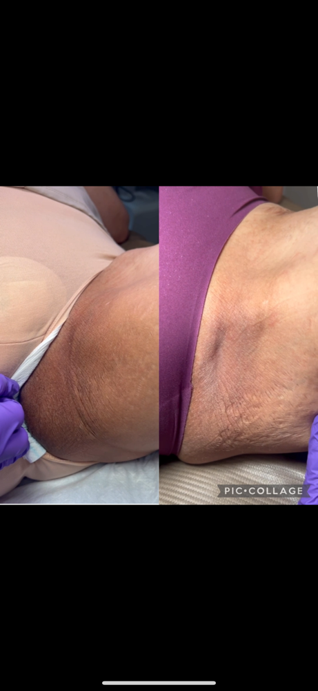 Inner Thigh Lightening Treatment