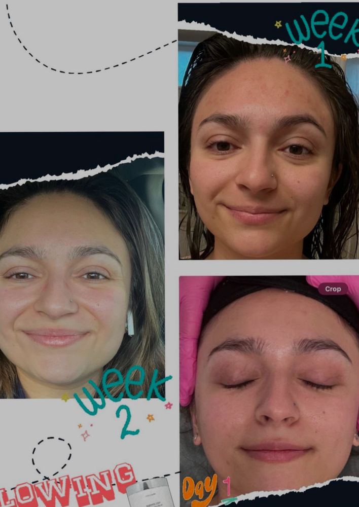Chemical Peel