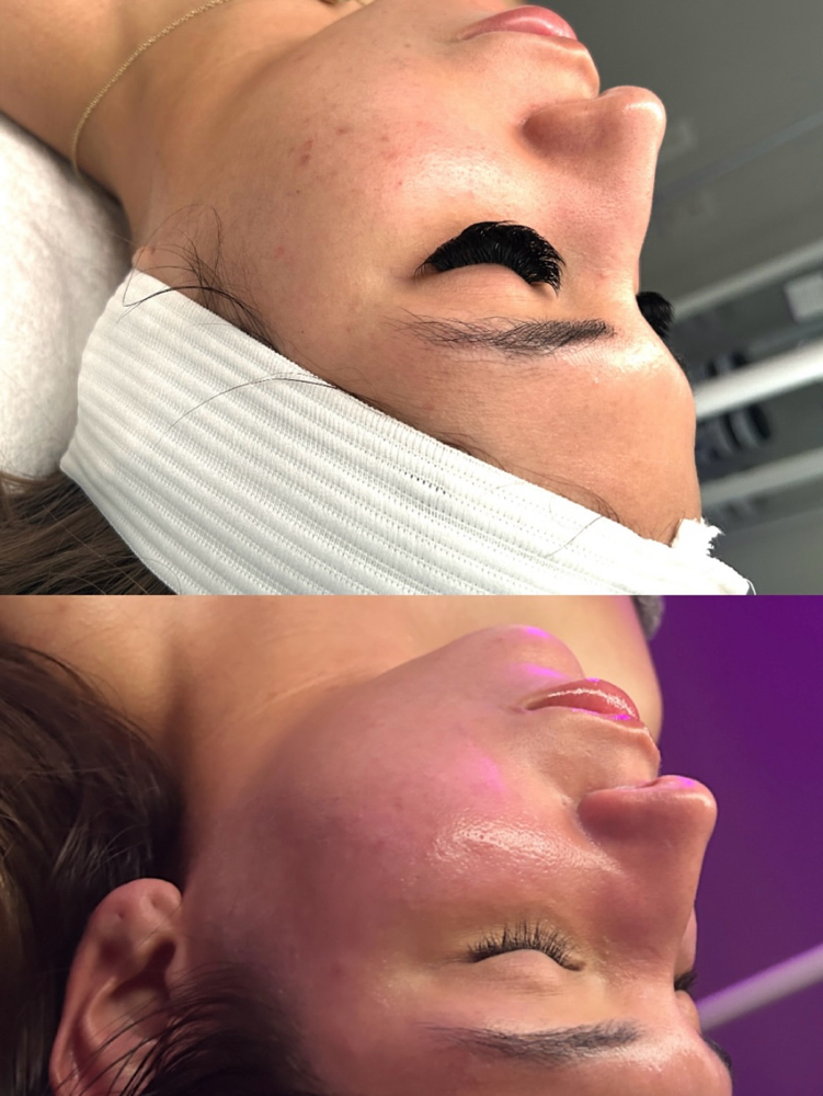 Acne Facial at Lily’s Beauty Therapy in Dallas, TX