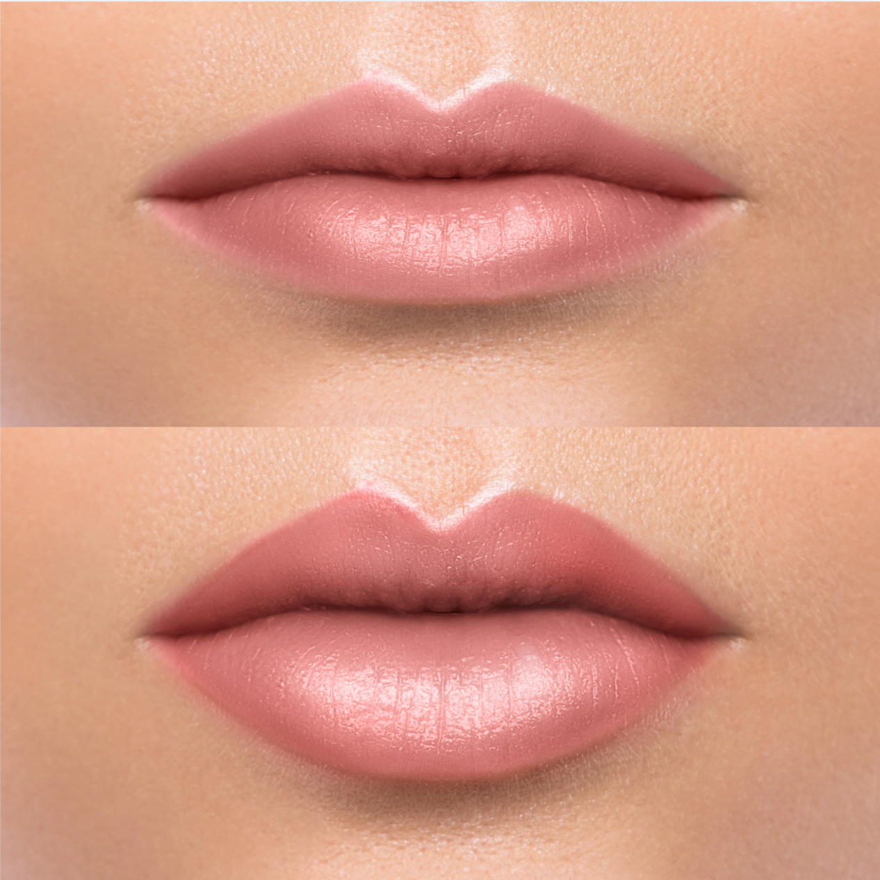 Lip Filler at Ultimate Solutions Medical Spa in Stamford, CT