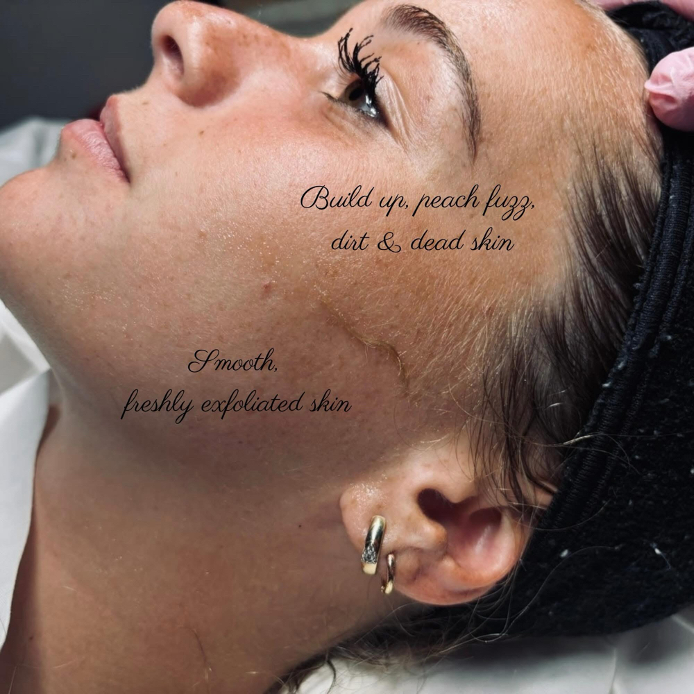 Glass Glow Dermaplane Facia at Radiant Glo Aesthetics in Ottawa, KS