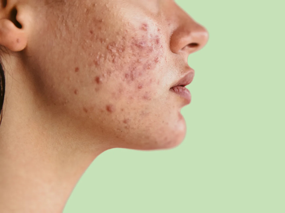 Acne Laser Facial (IPL)