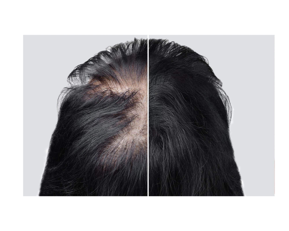 SCALP  ADDING  DENSITY