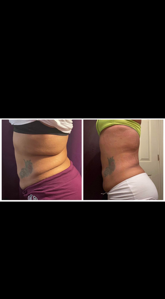 Stomach & Back Injections/Deluxe Butt Injections