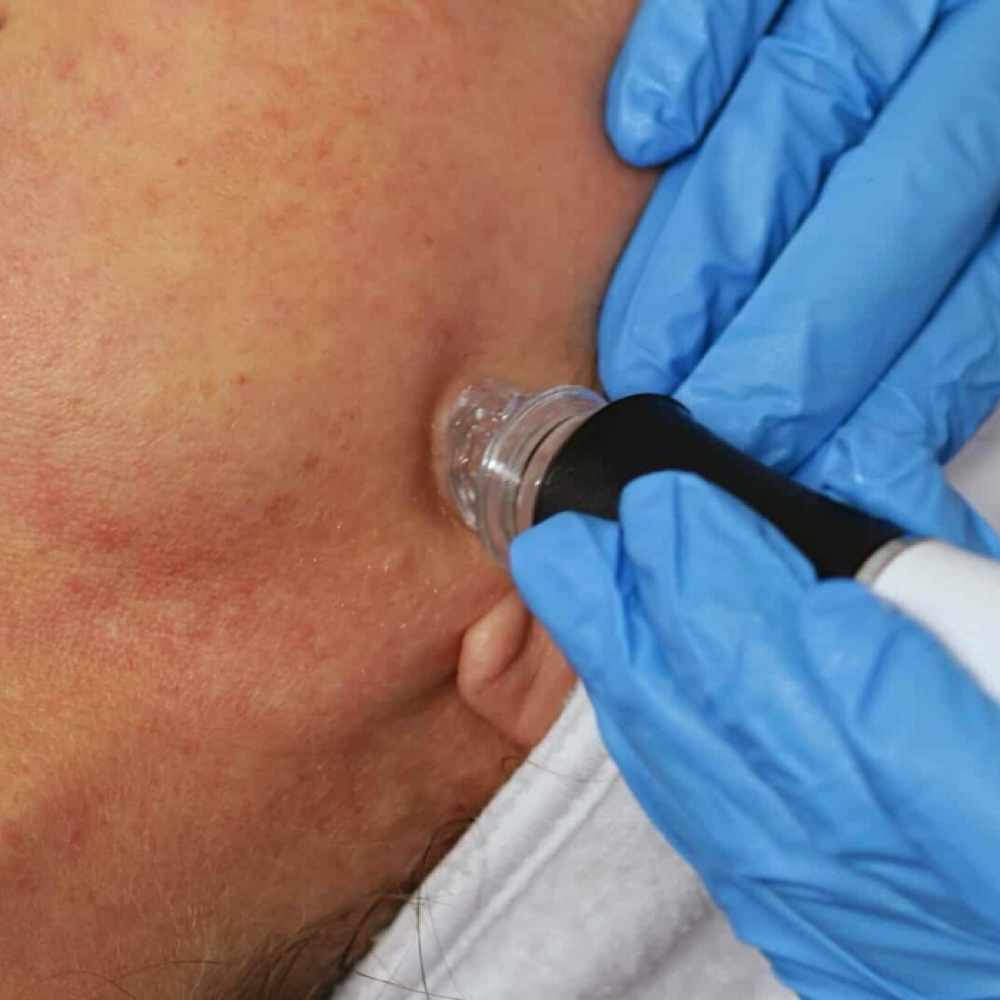 Aquafirme hydration peptide facial at Arosa Aesthetics in Reno, NV