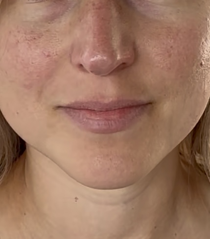 Chin Threading