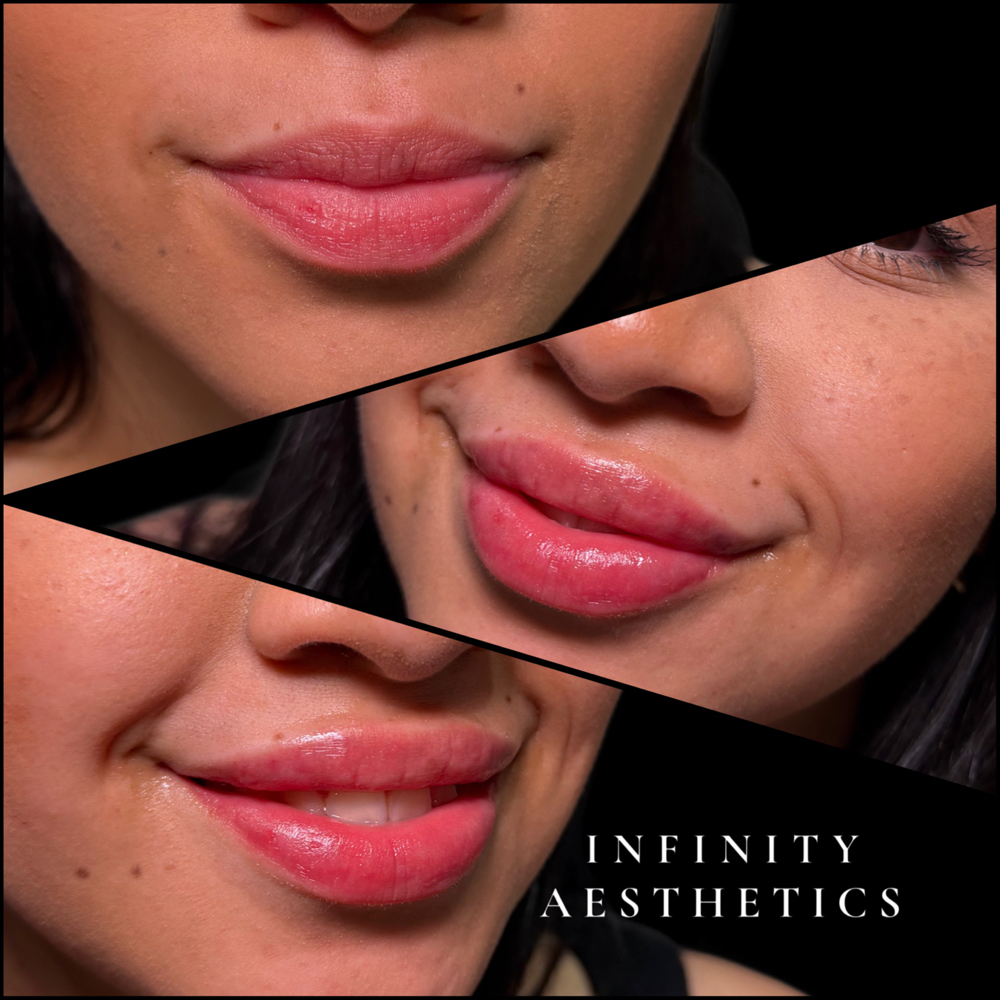 Lip Enhancements at Infinity Aesthetics in Elsa, TX