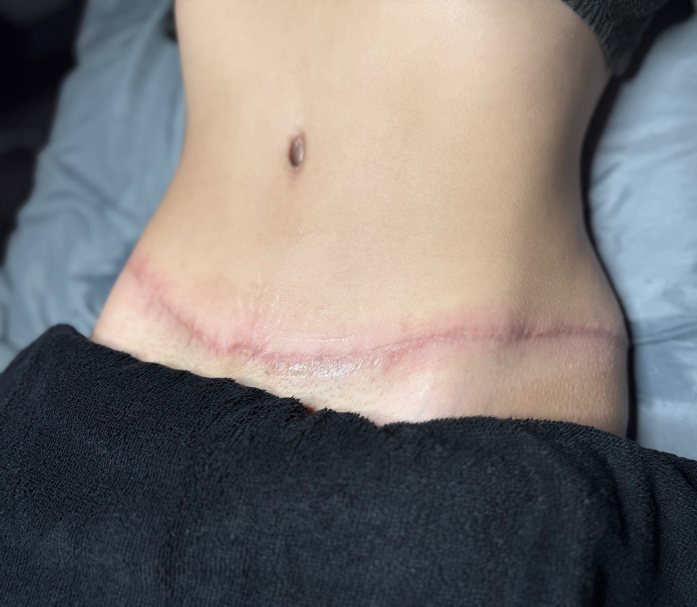 Scar Resurfacing