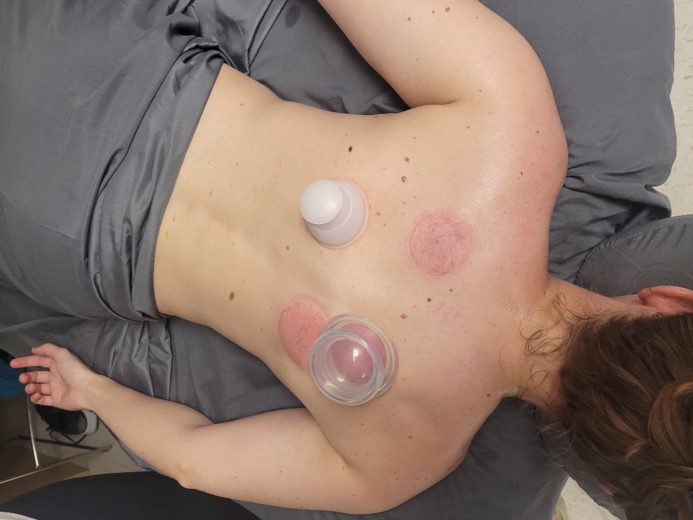 Cupping