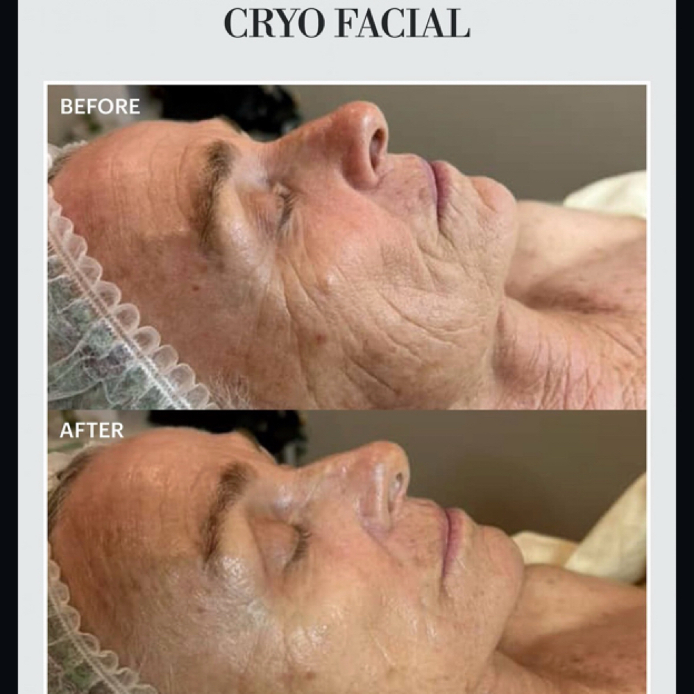 Premium Facial Triple Peptide, Cryo