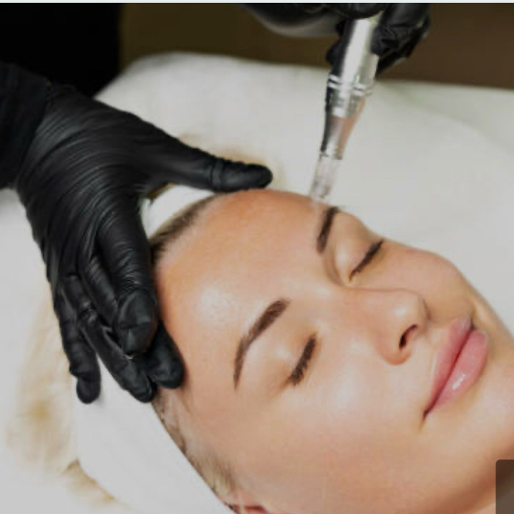 Microneedling at SkinbyKimberly in Cornelius, NC
