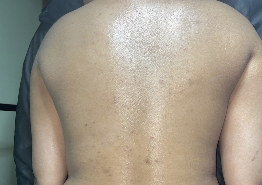 Detoxifying Back Treatment