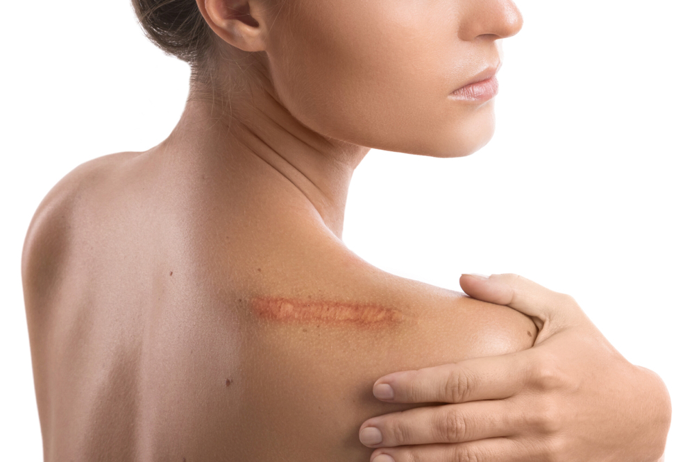 Scar Treatment