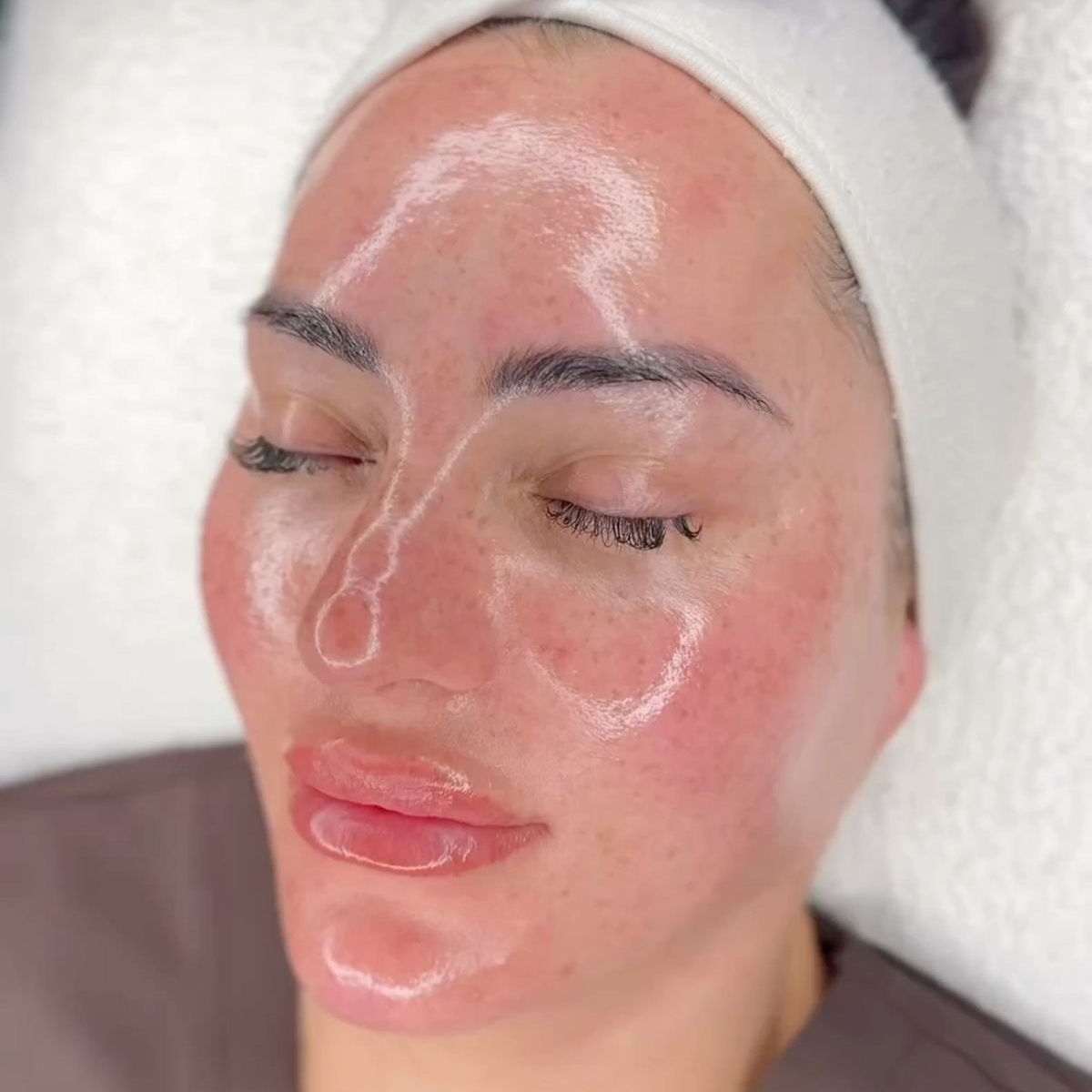 Chemical Peel at Shelby Langston in Brock, TX
