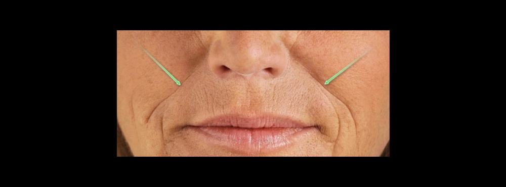 Nasolabial Fold (Smile Lines) at Pin Me Aesthetics PLLC in Alvin, TX