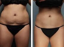 FULL ABDOMEN ~Upper & Lower