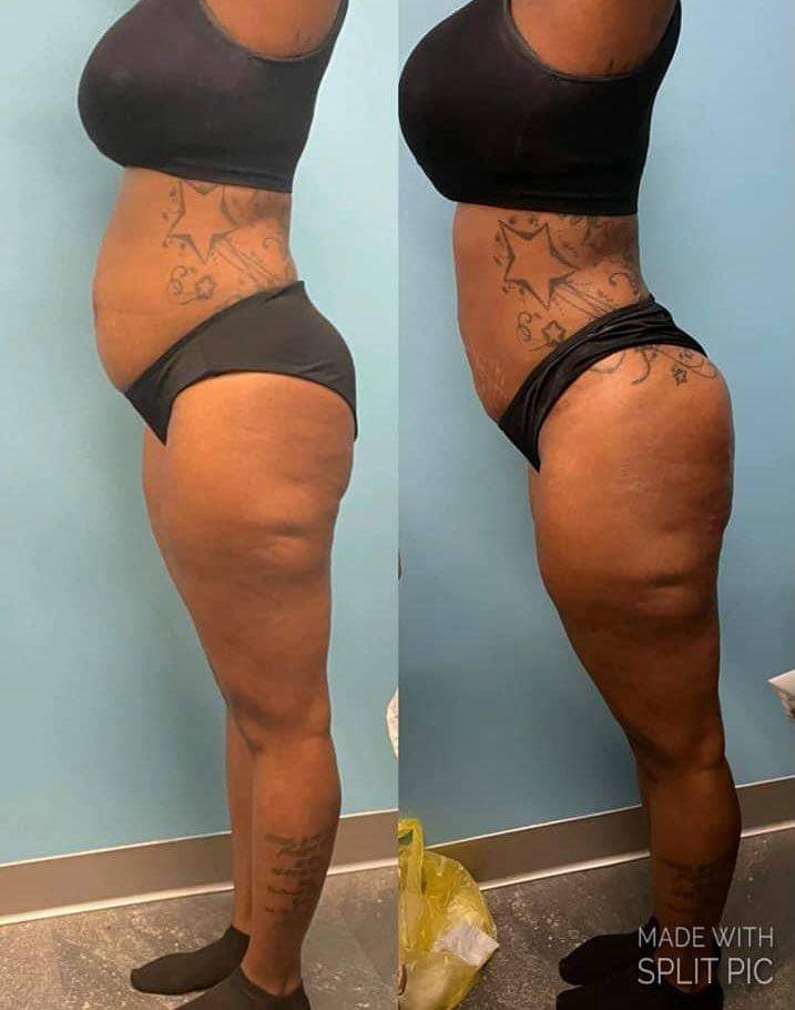 Utrasonic Cavitation at Beauty by Shaddai in Ocala, FL