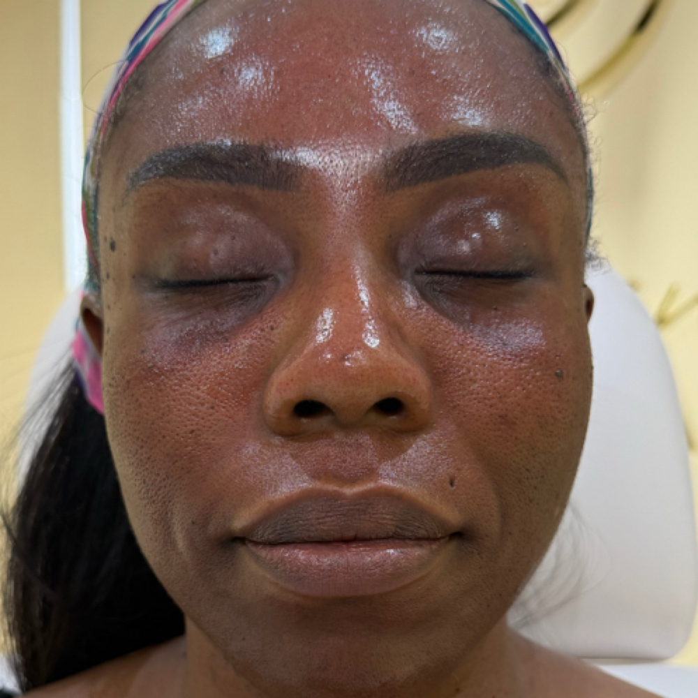 Microneedling at Olive Branch Medspa in Los Angeles, CA