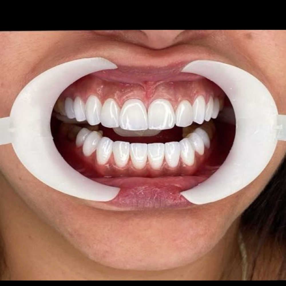 Teeth Whitening Option:2