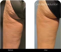 Bye Bye Cellulite!