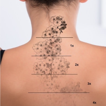 Tatoo Removal at The Beautee Spot in Phoenix, AZ
