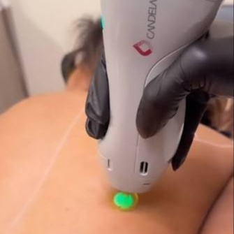 Full Back at Illumina Aesthetics and Laser in Palm Beach Gardens, FL