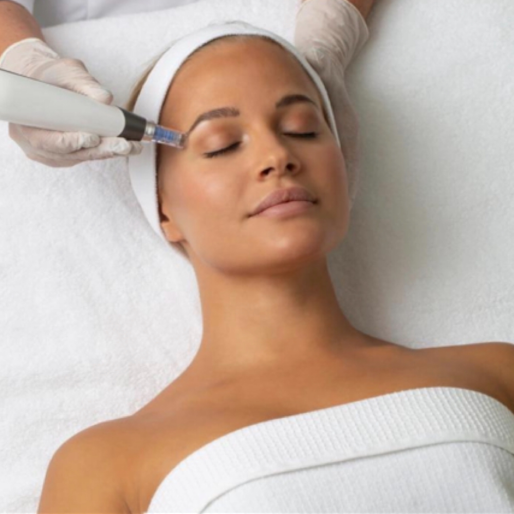 Microneedling package at Sunshine Esthetics Lounge in Lake Mary, FL
