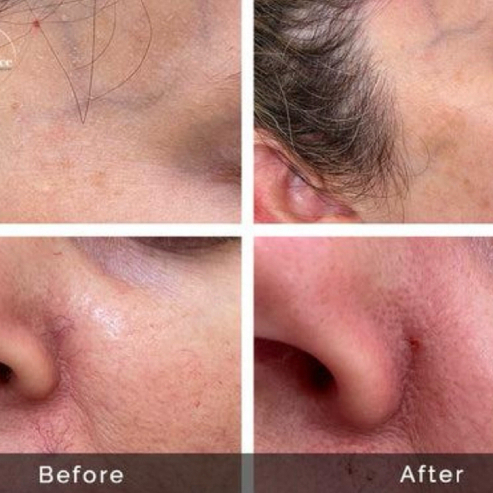 Skin Classic Thermolysis Treatment at Beyond Beauty & Glow in Lincolnshire, IL