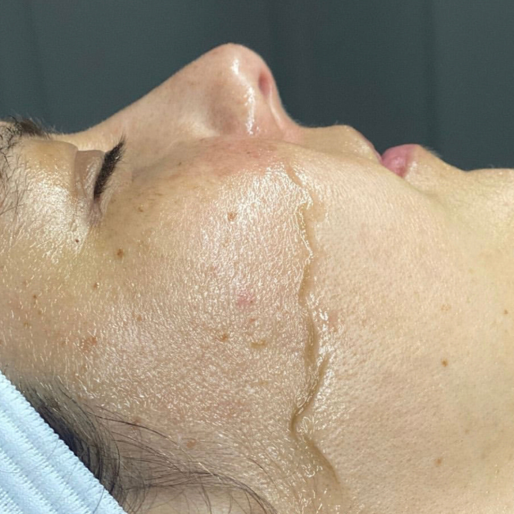 DERMAPLANE TREATMENT