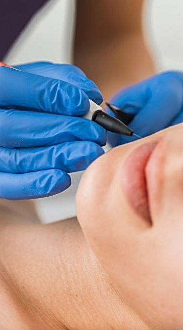 Permanent Hair Removal
