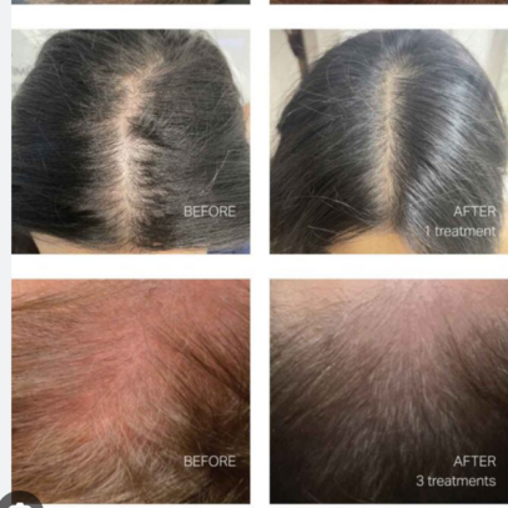 Kerivive Hair Growth Treatment at Beauty And Body in San Dimas, CA