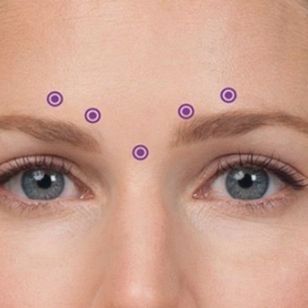 Glabellar Injection at Precision Aesthetics LLC in Harrodsburg, KY