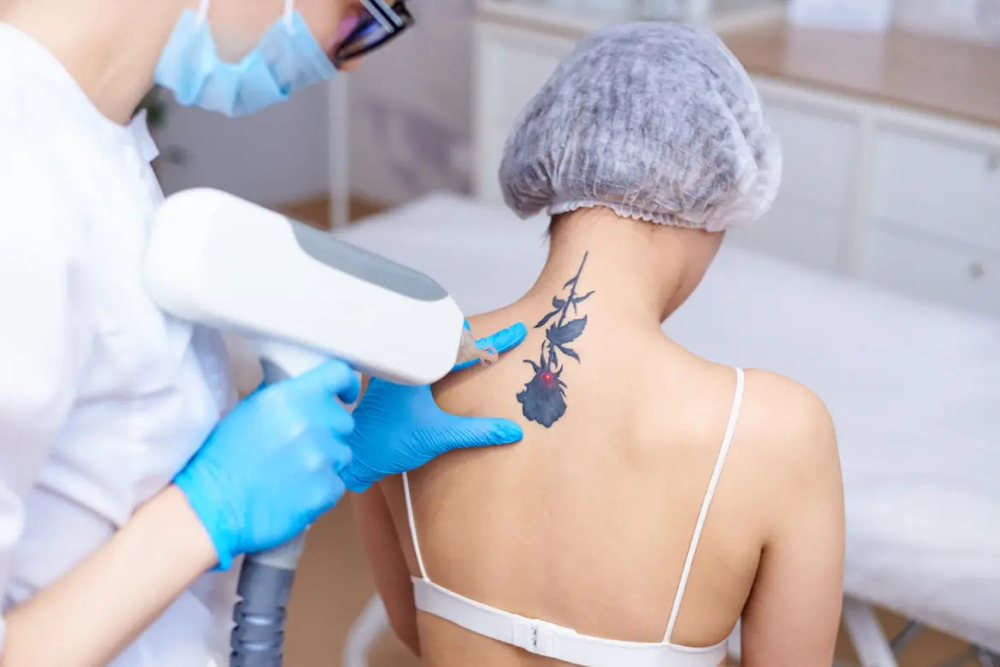 Tattoo Removal