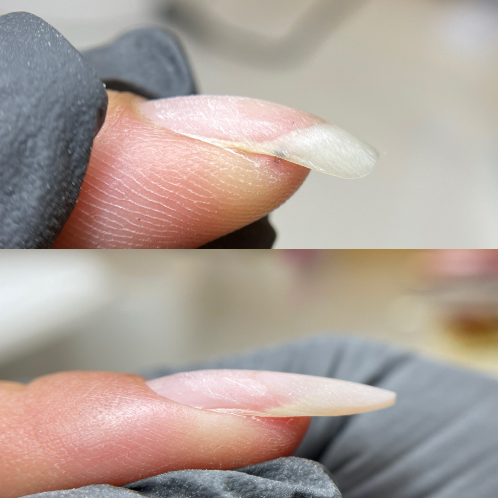 Down-Growing Nails Lifting