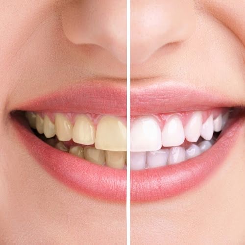 Blanqueamiento Dental at Ale Esthetics Studio in Selden, NY