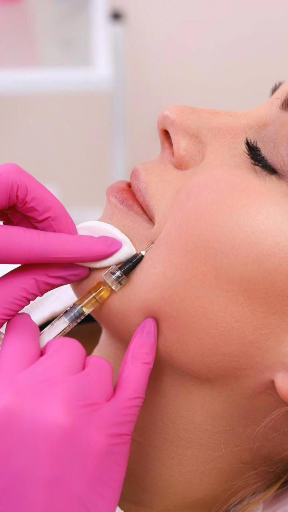 Nasolabials | Smile Line Filler 1ml