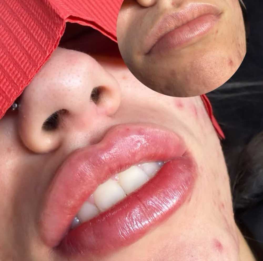 Lip Filler - 0.5ML (TOUCH UP) at Secret Beauty Studio in Ok, OK