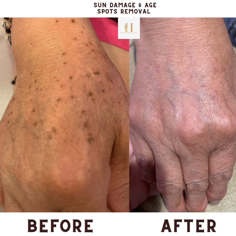 Skin Tags Removal